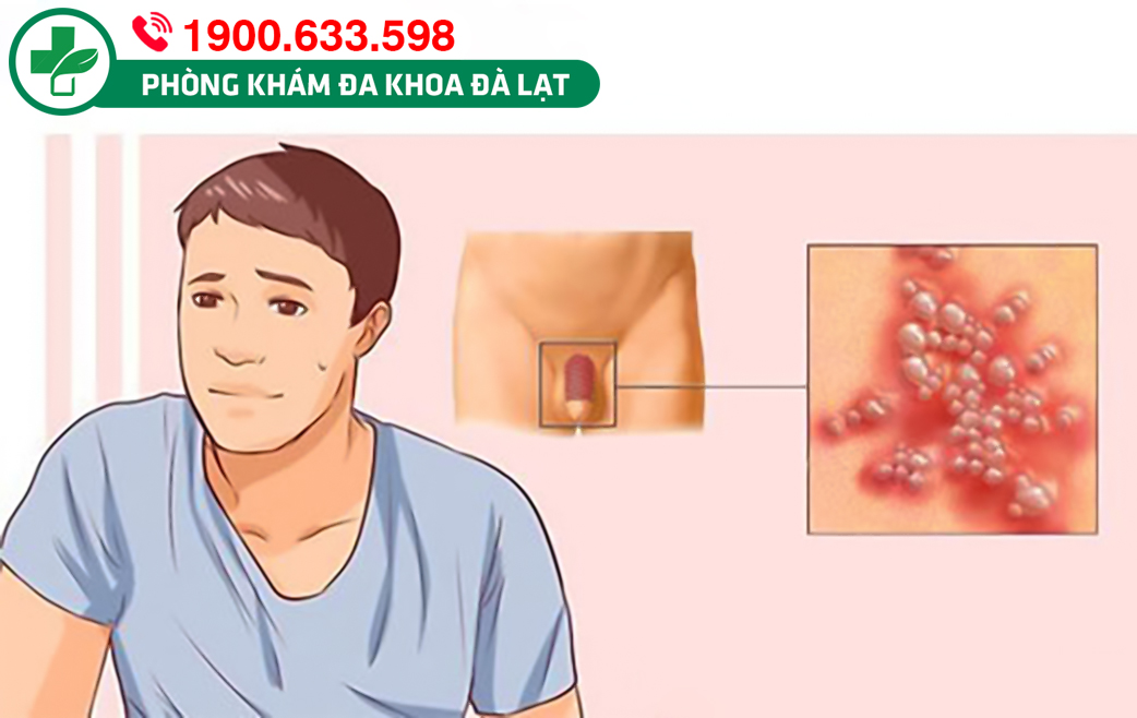 MỤN NƯỚC Ở BỘ PHẬN SINH DỤC NAM: CẢNH BÁO BỆNH LÝ NGUY HIỂM